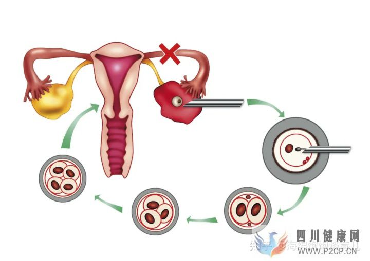 试管婴儿1代、2代、3代、4代哪个最好真实操作过...(第二代试管婴儿成功率有多少)(图7) 试管婴儿1代、2代、3代、4代哪个最好真实操作过...(第二代试管婴儿成功率有多少)(图7)