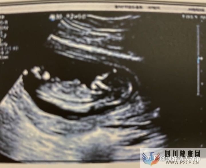 老公严重少弱精,二代试管一次成功(内附取卵后注...(第二代试管婴儿成功率有多少)(图16) 老公严重少弱精,二代试管一次成功(内附取卵后注...(第二代试管婴儿成功率有多少)(图16)