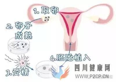 试管婴儿的一个基本流程和周期时间(二代试管婴儿需要多长时间)(图2) 试管婴儿的一个基本流程和周期时间(二代试管婴儿需要多长时间)(图2)
