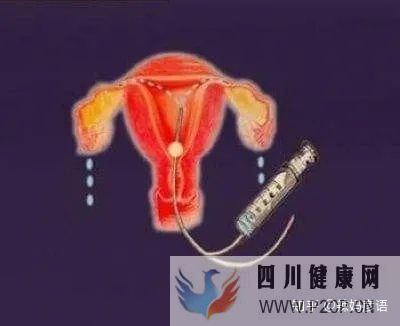 输卵管堵塞到底是先做手术,还是直接试管婴儿(女方输卵管堵塞做试管婴儿需要多长时间)(图5) 输卵管堵塞到底是先做手术,还是直接试管婴儿(女方输卵管堵塞做试管婴儿需要多长时间)(图5)
