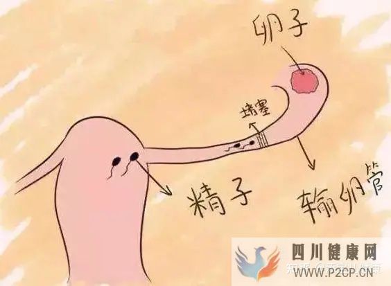 输卵管不孕做试管婴儿手术过程中,常见的六个问题(女方输卵管堵塞做试管婴儿需要多长时间)(图2)