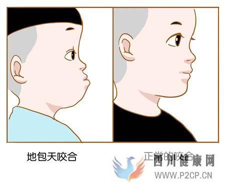 地包天对口腔的影响比你想的要大!(图1) 地包天对口腔的影响比你想的要大!(图1)
