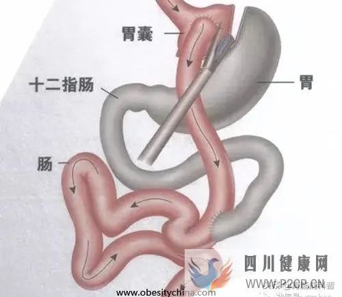 手术也能治糖尿病?一文了解——胃旁路术(图1) 手术也能治糖尿病?一文了解——胃旁路术(图1)