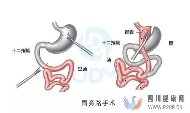 糖尿病的治疗方法,胃旁路手术费用多少钱?(图1) 糖尿病的治疗方法,胃旁路手术费用多少钱?(图1)