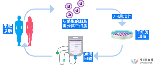 肝硬化、脂肪肝、肝功能不全等肝脏疾病的治疗日本干细胞效果如何(干细胞的效果)(图4) 肝硬化、脂肪肝、肝功能不全等肝脏疾病的治疗日本干细胞效果如何(干细胞的效果)(图4)