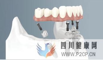 糖尿病对人工种植牙的影响(图1) 糖尿病对人工种植牙的影响(图1)