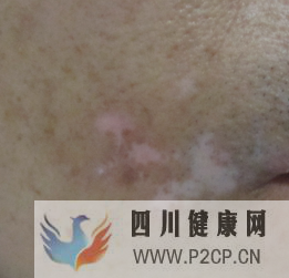 不同时期的白癜风症状是什么样的(图1) 不同时期的白癜风症状是什么样的(图1)
