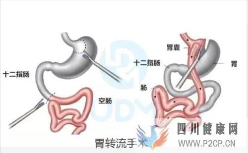 糖尿病手术治疗,血糖高可以治好吗(图1) 糖尿病手术治疗,血糖高可以治好吗(图1)