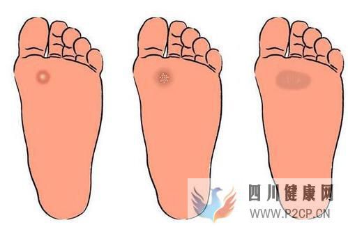 糖尿病在出现烂脚这个并发症之前有什么征兆没有?(图1) 糖尿病在出现烂脚这个并发症之前有什么征兆没有?(图1)