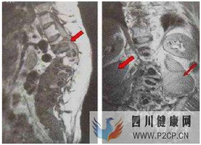 什么是化脓性骨髓炎,化脓性骨髓炎的症状有哪些?(图1) 什么是化脓性骨髓炎,化脓性骨髓炎的症状有哪些?(图1)