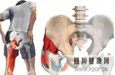 股骨头坏死病发后的症状表现有哪些(图1) 股骨头坏死病发后的症状表现有哪些(图1)
