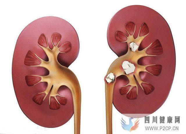 糖尿病患者吃杨桃引发肾炎,肾病患者哪些蔬菜水果不能吃?(图1) 糖尿病患者吃杨桃引发肾炎,肾病患者哪些蔬菜水果不能吃?(图1)
