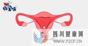 输卵管不通怎么办!(图5) 输卵管不通怎么办!(图5)