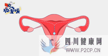 输卵管不通怎么办!(图4) 输卵管不通怎么办!(图4)