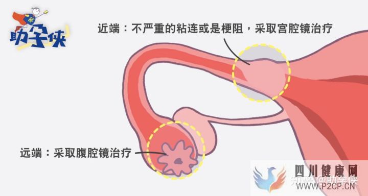 输卵管不通怎么办!(图7) 输卵管不通怎么办!(图7)