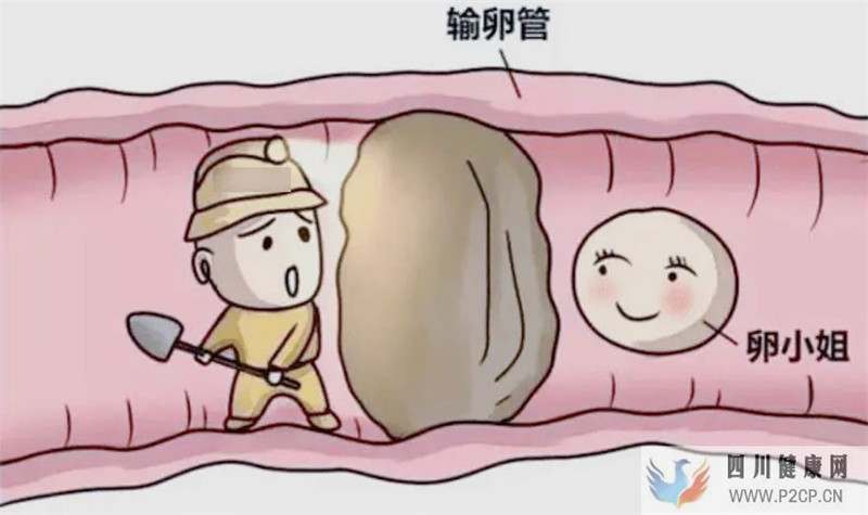 输卵管堵塞分几级(图1) 输卵管堵塞分几级(图1)