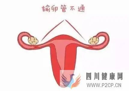 女性为什么会出现输卵管堵塞?(图1) 女性为什么会出现输卵管堵塞?(图1)