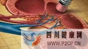 她患糖尿病2年就被诊断为糖尿病肾病晚期,你的糖尿病肾病预防工作做得好吗(图1) 她患糖尿病2年就被诊断为糖尿病肾病晚期,你的糖尿病肾病预防工作做得好吗(图1)