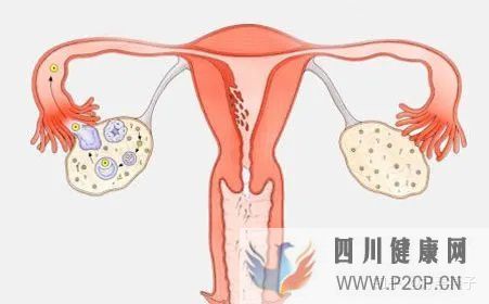 不孕症的自我诊断(图4) 不孕症的自我诊断(图4)