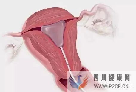 不孕症的自我诊断(图8) 不孕症的自我诊断(图8)