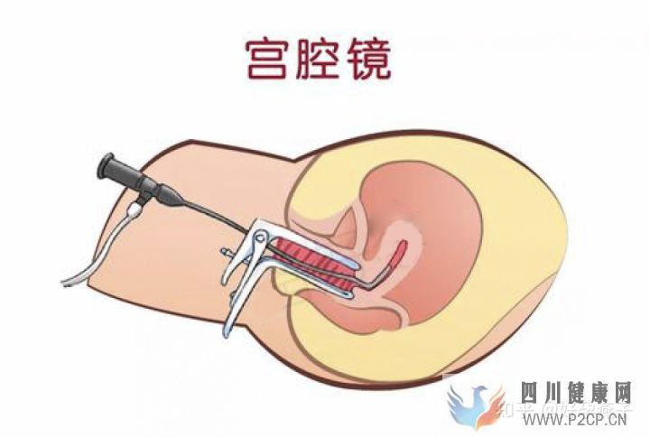 不孕症的自我诊断(图5) 不孕症的自我诊断(图5)