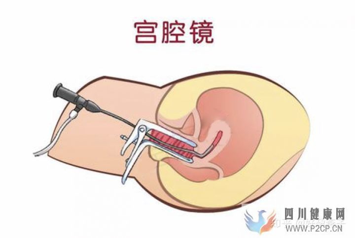 不孕症的自我诊断(图6) 不孕症的自我诊断(图6)