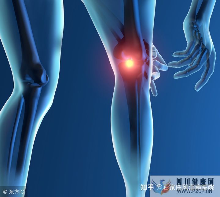 风湿的症状有哪些该如何预防风湿真相马上揭晓(图2) 风湿的症状有哪些该如何预防风湿真相马上揭晓(图2)