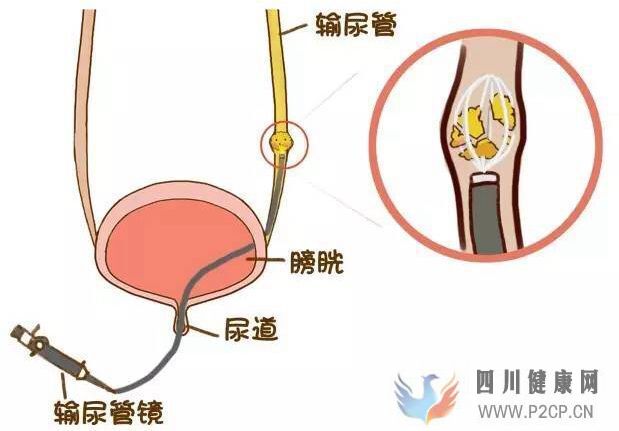得了肾结石怎么治疗比较好?(图1) 得了肾结石怎么治疗比较好?(图1)
