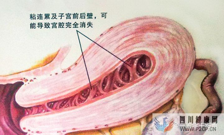 干细胞的4大作用,帮助修复宫腔粘连所致的子宫内膜...(图1) 干细胞的4大作用,帮助修复宫腔粘连所致的子宫内膜...(图1)