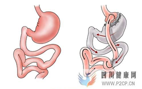 打败糖尿病传统治疗法?胃旁路手术真的这么厉害吗(图1) 打败糖尿病传统治疗法?胃旁路手术真的这么厉害吗(图1)